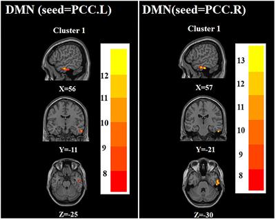 Altered functional connectivity in first-episode and recurrent depression: A resting-state functional magnetic resonance imaging study